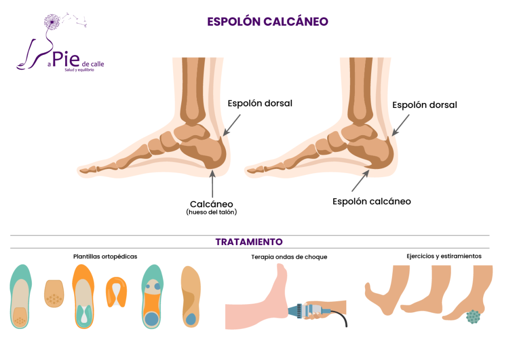 Spolon Radiography Duración del tratamiento del espolón calcáneo